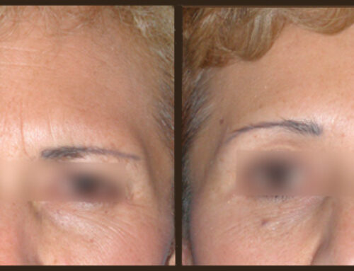 CONSEJOS ANTES DE APLICAR EL BOTOX – Dra. Lina Vanegas