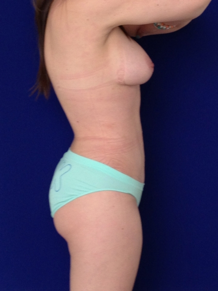 cirugia plastica despues del embarazo