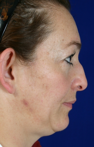 se pueden arreglar las gibas de la nariz con cirugia