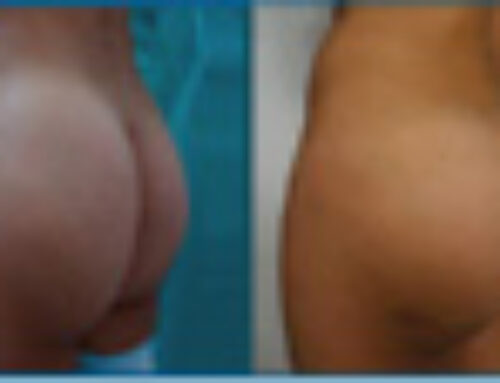 Ventajas de las cirugías plásticas para la cola – Dr. Alejandro Chiappe