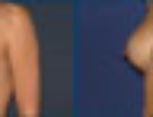 Mamoplastia de aumento: consejos por la Dra. Lina Vanegas