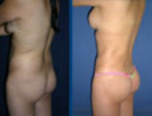 Lipolaser en Bogotá – Dra. Lina Vanegas