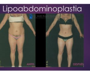 caso frontal de una lipo abdominoplastia